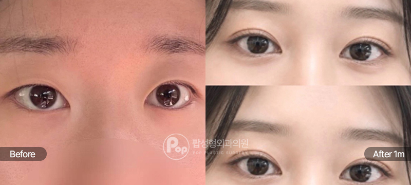 12홀 자연유착 윗트임 앞트임 눈재수술 1개월차 전후 비교