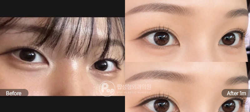 12홀 자연유착 눈재수술 1개월차 전후 비교