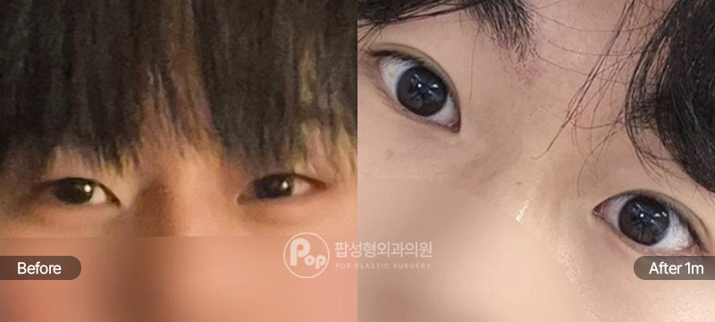 12홀 자연유착 눈매교정 밑트임 남자눈성형 전후 비교