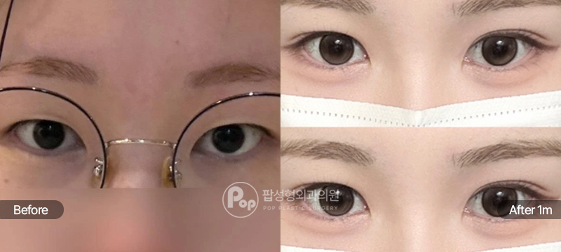 12홀 자연유착 눈매교정 윗트임 전후 비교