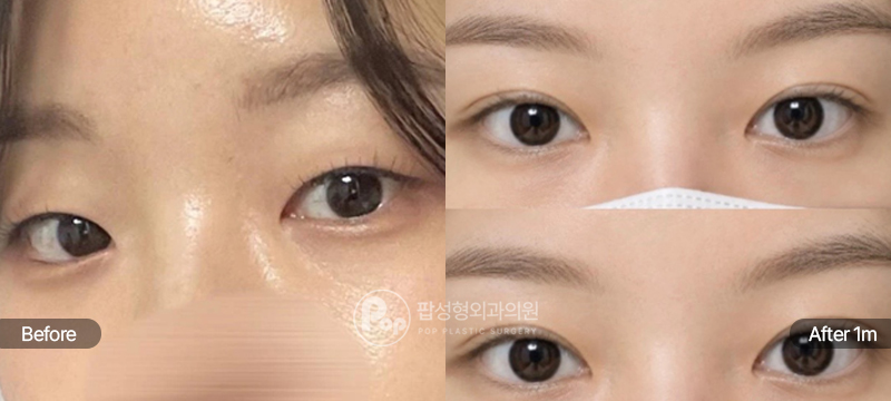 12홀 자연유착 눈매교정 윗트임 앞트임 눈위지방제거 전후 비교