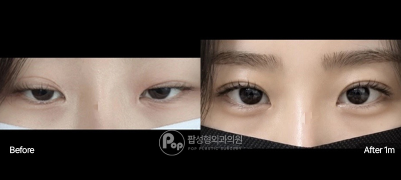 절개쌍꺼풀 눈매교정 눈재수술 전후 비교