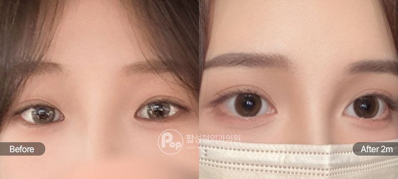 12홀 자연유착 눈매교정 윗트임 앞트임 눈재수술 전후 비교
