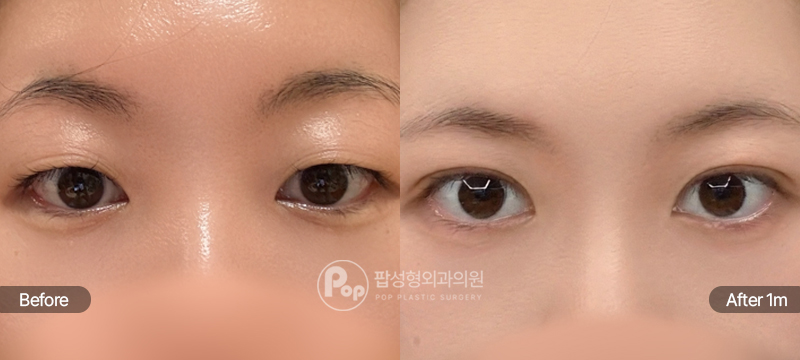 팝성형외과 12홀 자연유착 쌍꺼풀 수술 전후 비교