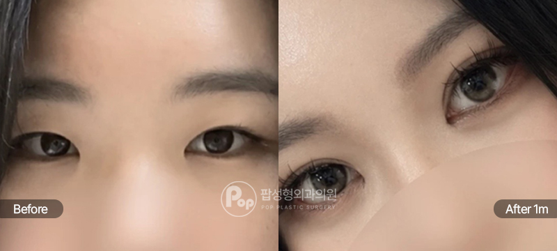 팝성형외과 12홀 자연유착 눈매교정 윗트임 앞트임 수술 전후 비교