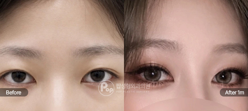 팝성형외과 앞트임 수술 전후 1개월차 비교 이미지