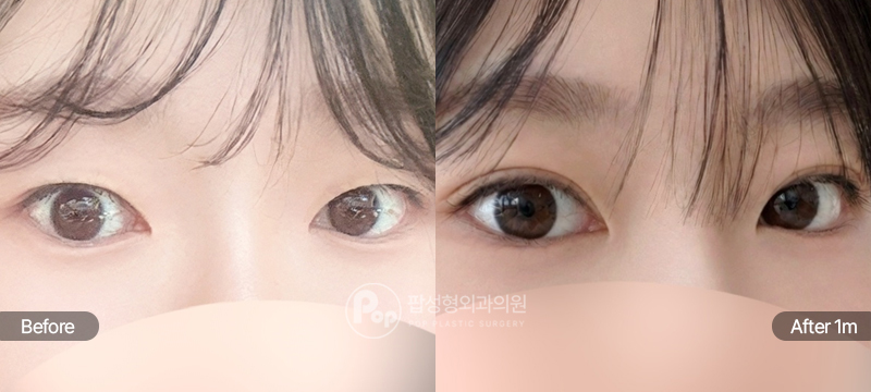 팝성형외과 12홀 자연유착 윗트임 수술 전후 1개월차 비교 이미지