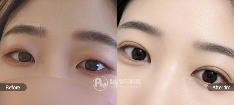 팝성형외과 12홀 자연유착 눈매교정 윗트임 앞트임 눈위지방제거 1개월차 전후 비교 이미지