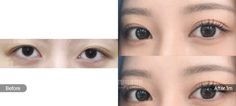 팝성형외과 12홀 자연유착 눈매교정 1개월차 전후 비교 이미지