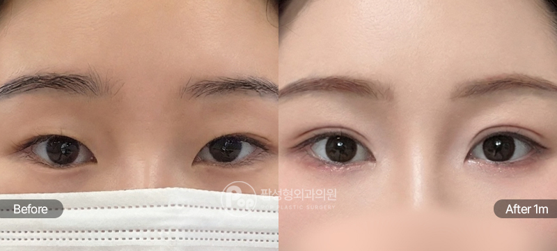 팝성형외과 12홀 자연유착 윗트임 앞트임 1개월차 전후 비교 이미지