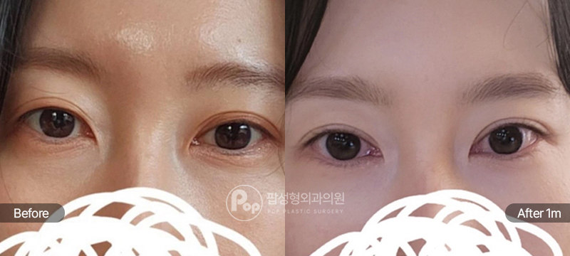 팝성형외과 12홀 자연유착 눈매교정 윗트임 앞트임 1개월차 전후 비교 이미지
