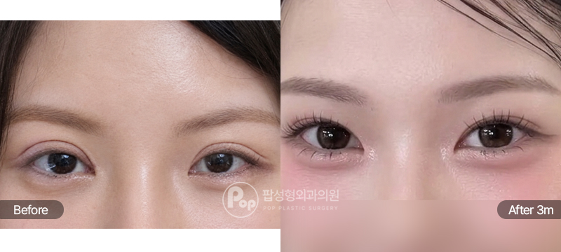 팝성형외과 12홀 자연유착 눈재수술 3개월차 전후 비교 이미지