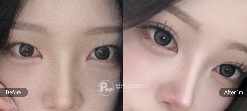 팝성형외과 12홀 자연유착 눈매교정 윗트임 앞트임 밑트임 눈재수술 1개월차 전후 비교 이미지