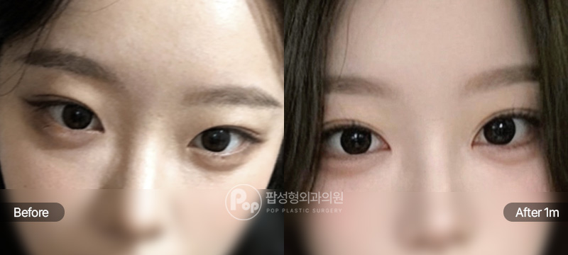 팝성형외과 12홀 자연유착 눈매교정 윗트임 앞트임 뒤트임 밑트임 눈재수술 1개월차 전후 비교