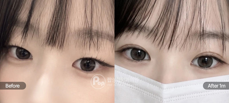 팝성형외과 12홀 자연유착 눈매교정 윗트임 눈위지방제거 1개월차 전후 비교