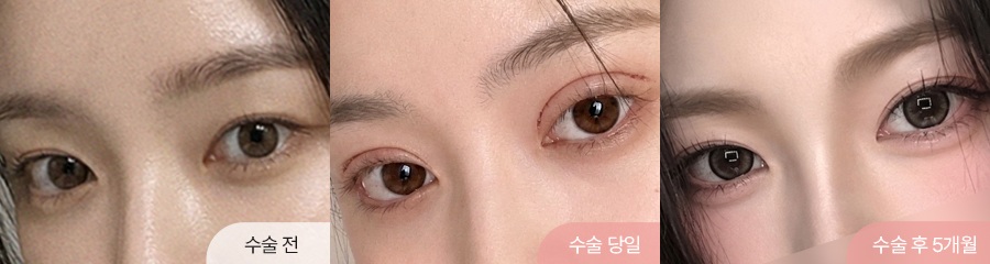 팝성형외과 12홀 자연유착 눈매교정 윗트임 수술 직후부터 5개월차 경과 비교