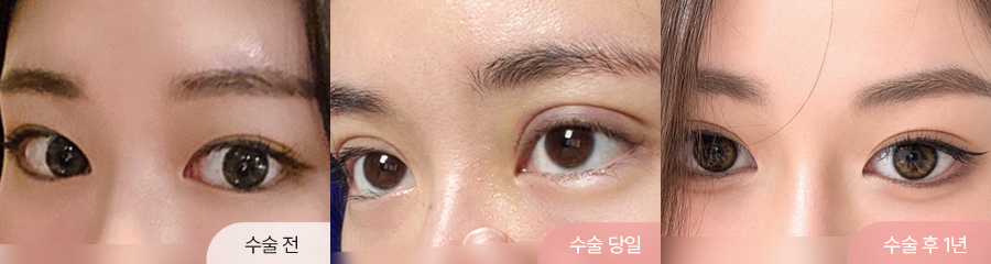 팝성형외과 12홀 자연유착 윗트임 수술 직후부터 1년차 경과 비교