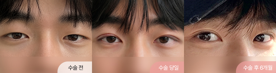 팝성형외과 남자 12홀 자연유착 눈매교정 윗트임 수술 직후부터 6개월차 경과 비교