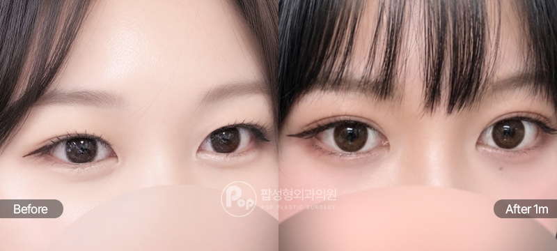 팝성형외과 12홀 자연유착 눈매교정 윗트임 눈위지방제거 1개월 전후