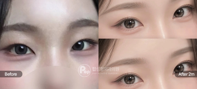 팝성형외과 12홀 자연유착 눈매교정 윗트임 2개월 전후