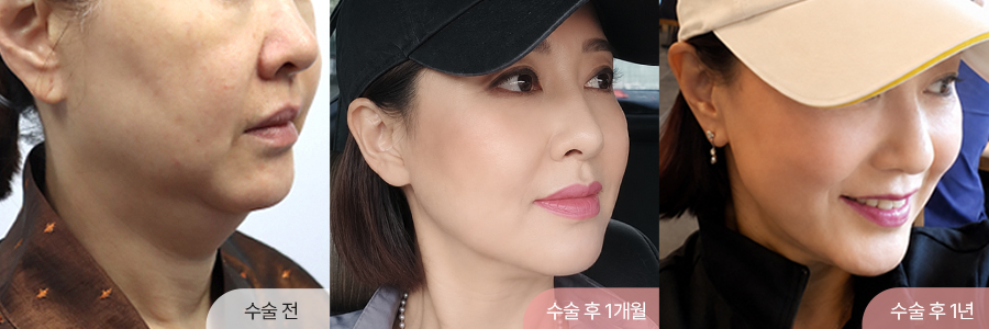 팝성형외과 미니거상 수술 후 1년차 피부 처짐과 턱선 리프팅 경과 이미지