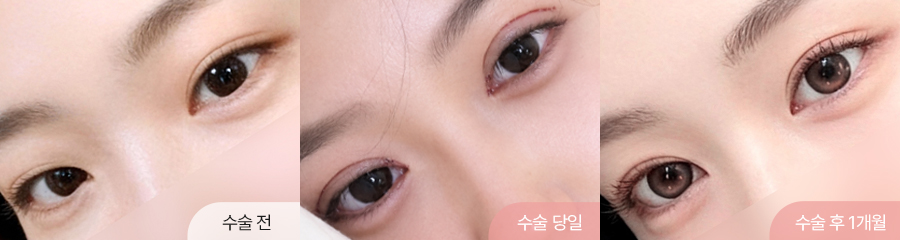 팝성형외과 12홀 자연유착 눈매교정 윗트임 앞트임 수술 후 1개월차 세미아웃라인 경과 이미지