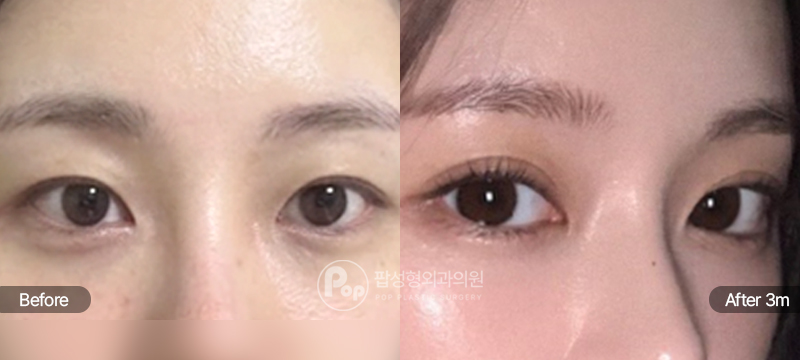 팝성형외과 12홀 자연유착 윗트임 앞트임 눈재수술 전후 3개월차 세미아웃라인 경과 이미지