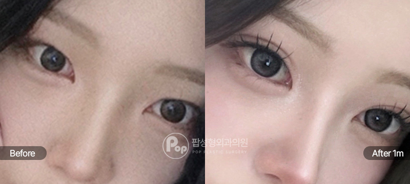 팝성형외과 12홀 자연유착 윗트임 앞트임 한쪽 쌍꺼풀 풀림 눈재수술 경과 이미지