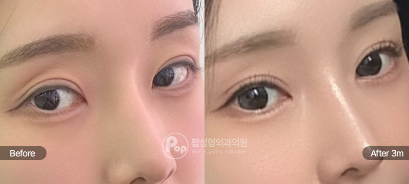 팝성형외과 12홀 자연유착 뒤트임 밑트임 눈위지방이식 함몰눈 눈재수술 3개월차 경과 이미지