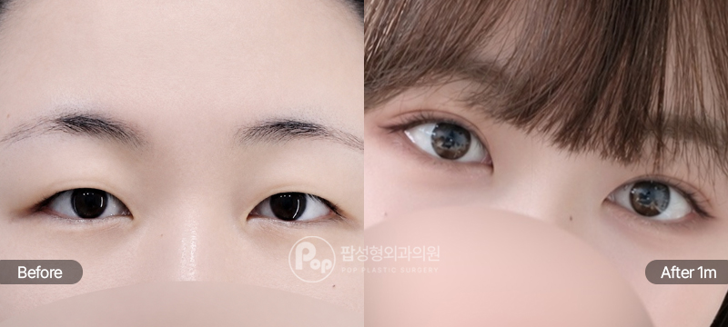 팝성형외과 12홀 자연유착 눈매교정 윗트임 눈위지방제거 무쌍 쌍꺼풀 수술 1개월차 경과 이미지