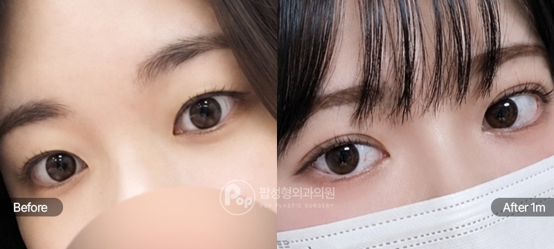 팝성형외과 12홀 자연유착 눈매교정 속쌍 쌍꺼풀 수술 후 1개월차 경과 이미지