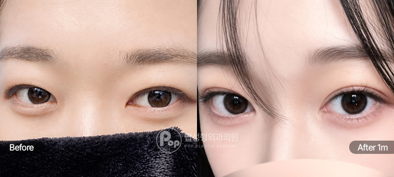 팝성형외과 12홀 자연유착 윗트임 앞트임 풀린 쌍꺼풀 라인 눈재수술 후 1개월차 경과 이미지