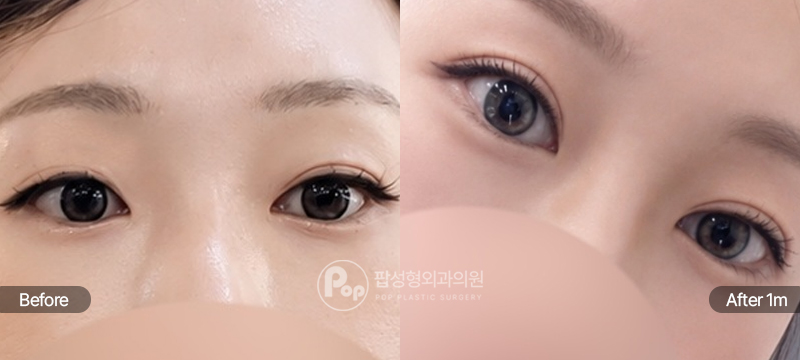 팝성형외과 12홀 자연유착 윗트임 눈매교정 풀린 라인 비대칭 눈재수술 1개월차 경과 이미지