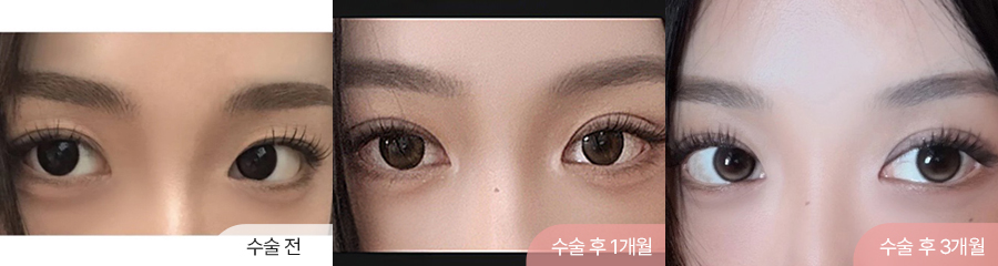 팝성형외과 12홀 자연유착 눈매교정 눈위지방이식 겹주름 쌍꺼풀 3개월차 경과 이미지