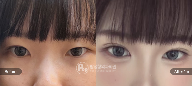 팝성형외과 12홀 자연유착 눈매교정 윗트임 앞트임 짝눈 비대칭 눈재수술 1개월차 경과 이미지