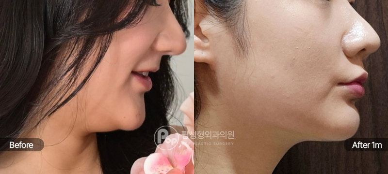 팝성형외과 이중턱 지방흡입 얼굴지방흡입 근육 묶기 1개월차 경과 이미지