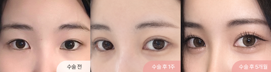 세미아웃라인 자연유착 앞트임 윗트임 뒤트임 눈매교정 5개월차 경과 이미지