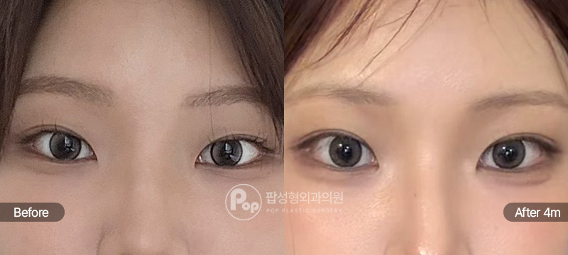 팝성형외과 12홀 자연유착 눈매교정 윗트임 앞트임 첫눈성형 4개월차 경과 이미지