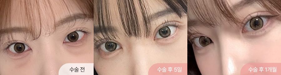 12홀 자연유착 눈매교정 윗트임 눈밑지방재배치 5일차 1개월차 경과 이미지