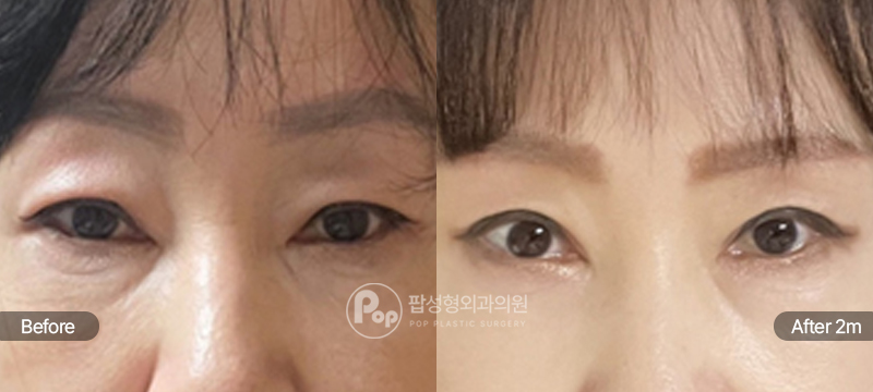 팝성형외과 12홀 자연유착 눈썹하거상 중년눈성형 2개월차 경과 이미지
