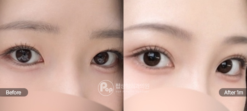 팝성형외과 12홀 자연유착 눈매교정 윗트임 앞트임 눈재수술 1개월차 경과 이미지
