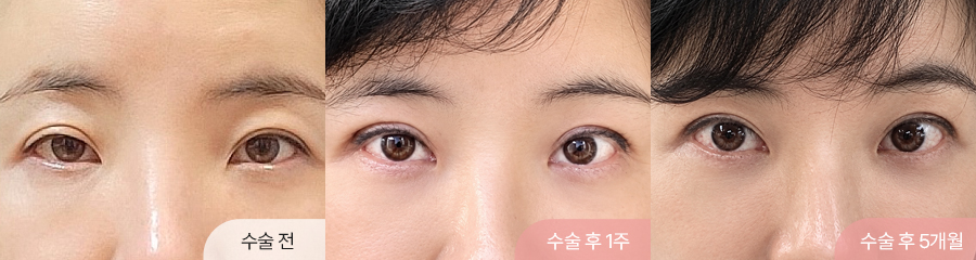 팝성형외과 상안검 눈매교정 앞트임 중년눈성형 1주차 5개월차 경과 이미지