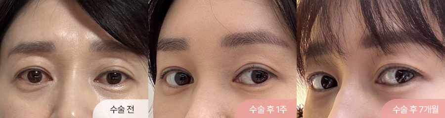 팝성형외과 이마거상 12홀 자연유착 중년눈성형 1주차 7개월차 경과 이미지