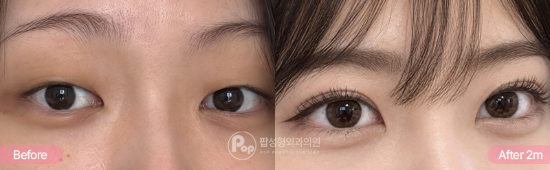 팝성형외과 12홀 자연유착 눈매교정 윗트임 인아웃라인 쌍꺼풀 2개월차 경과 이미지