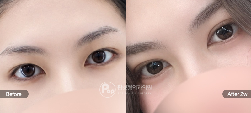 팝성형외과 12홀 자연유착 윗트임 인아웃라인 쌍꺼풀 2주차 경과 이미지
