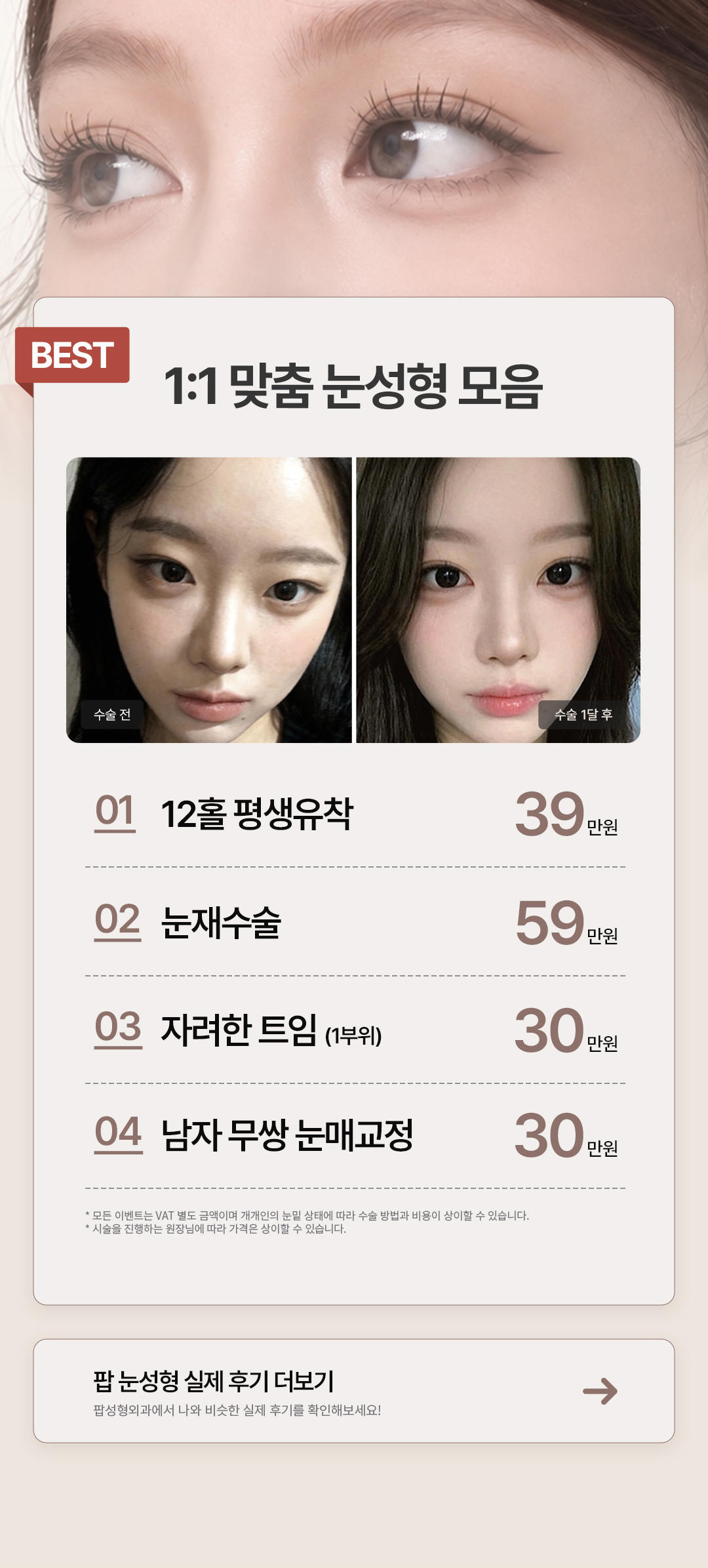 팝 눈성형 1:1 맞춤 눈성형 모음