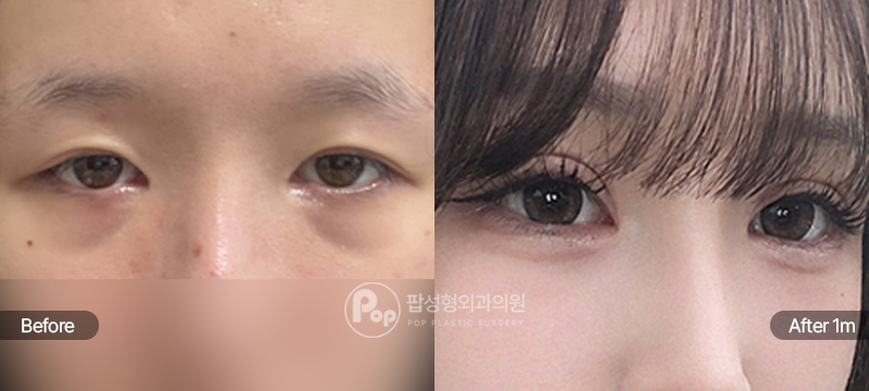 12홀 자연유착 눈매교정 윗트임 눈밑지방재배치 눈재수술 1개월차 경과 후기