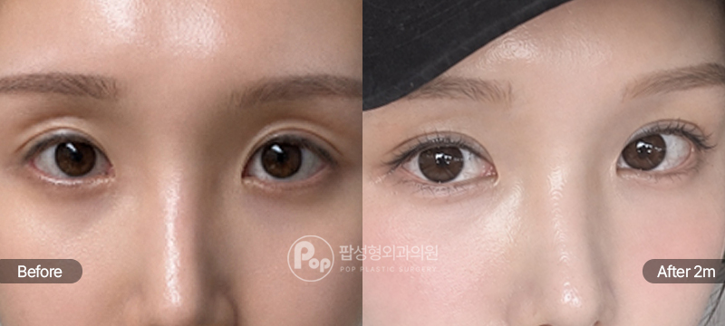 팝성형외과 눈재수술 두줄따기 눈매교정 눈위지방재배치 2개월차 경과 이미지