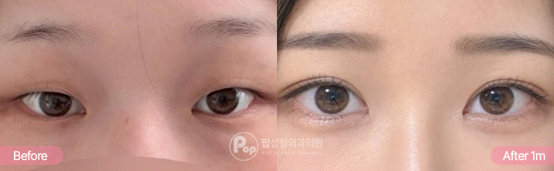 팝성형외과 자연유착 눈매교정 앞트임 윗트임 눈밑지방재배치 1개월차 경과 이미지