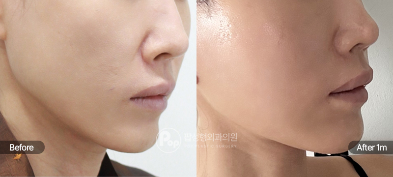 팝성형외과 안면거상 1개월차 측면 경과 이미지